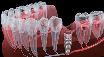 Illustration of dental implant placed in gum tissue