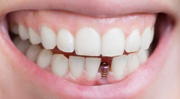 Smile with dental implant