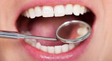 Teeth examined with dental mirror