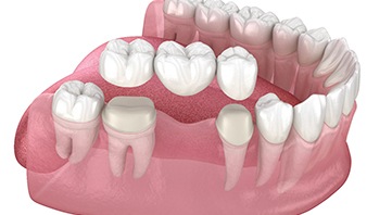 an example of a traditional dental bridge