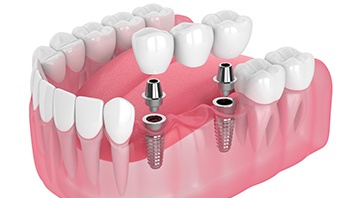an example of an implant bridge
