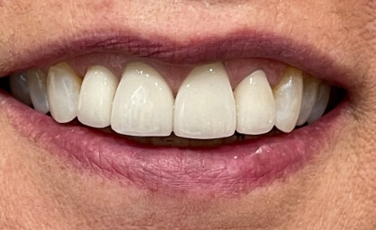 Flawless smile after cosmetic dentistry