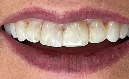 Damaged smile before cosmetic dentistry