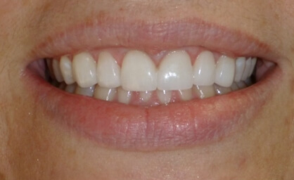 Bright smile after teeth whitening