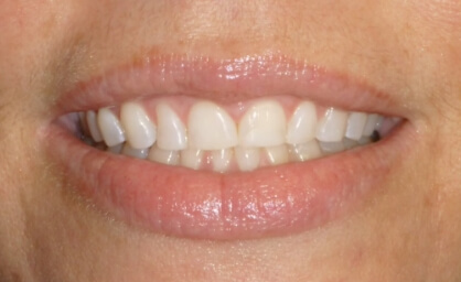 Yellowed smile before teeth whitening