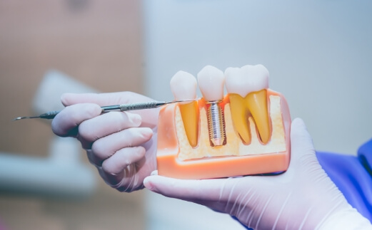 Model smile comparing natural tooth to dental implant replacement tooth