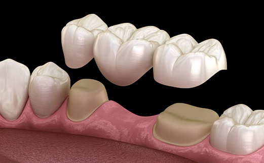 Animated smile during dental bridge placement