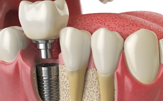 Animated smile during dental implant restoration