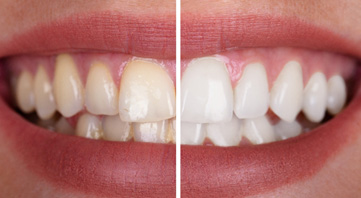 factors that can affect the cost of teeth whitening include how deeply stained your teeth are