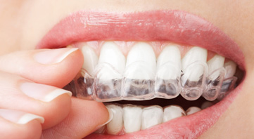 different types of teeth whitening have different price points