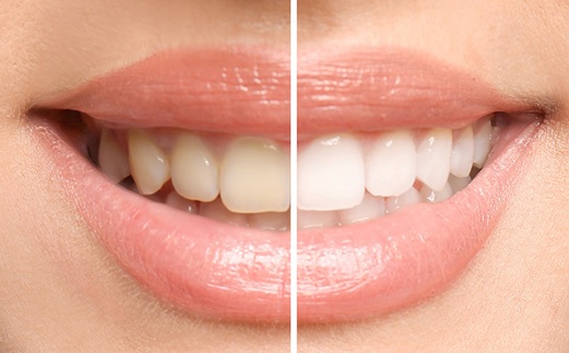 Closeup of a smile that’s half whitened