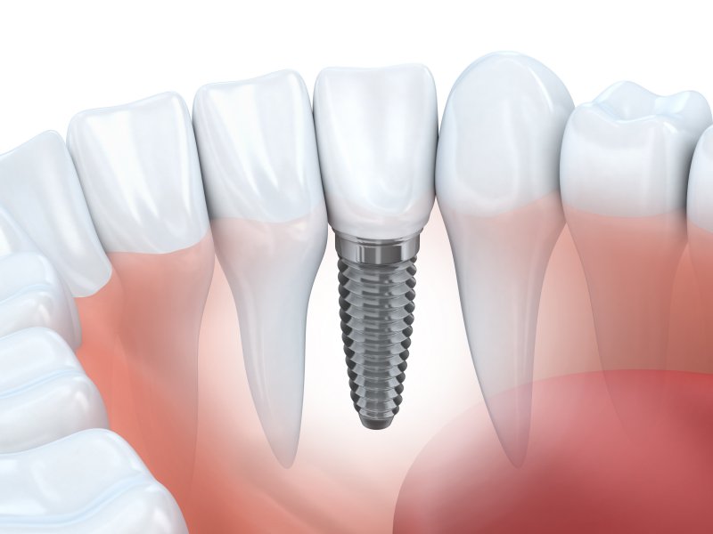 Illustration of a dental implant in the lower arch